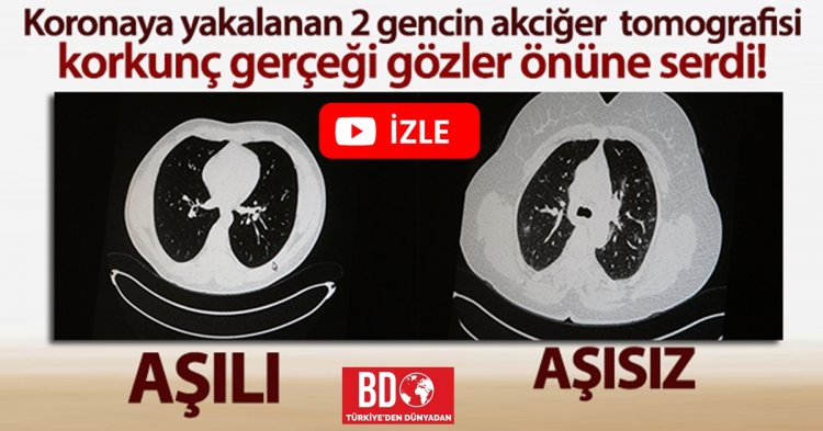 Aşılı ve aşısız olarak koronaya yakalanan 2 gencin akciğer tomografisi gerçeği gözler önüne serdi!